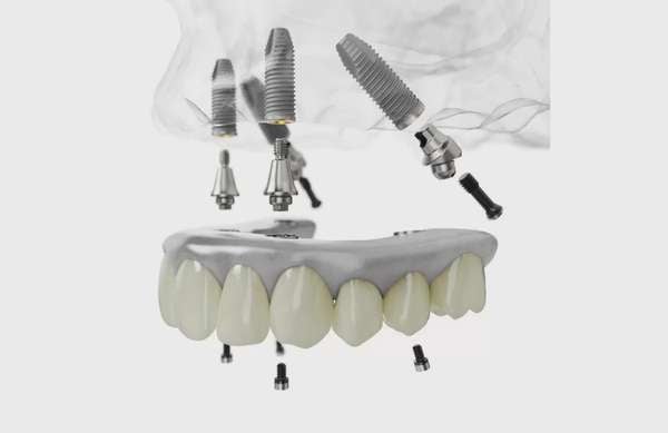 Trồng răng implant all on 4 tại Bệnh Viện Răng Hàm Mặt Sài Gòn