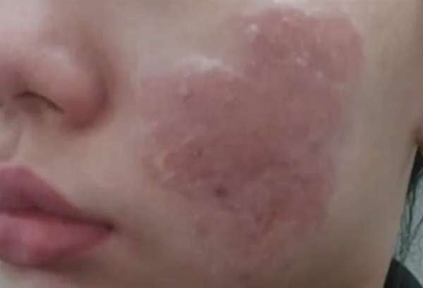 Làn da Hoa sau thời gian dùng cao trị mụn thảo dược không rõ nguồn gốc. Ảnh: Bác sĩ cung cấp