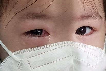 Đau mắt đỏ ở trẻ em: Khi nào cần đi bác sĩ?