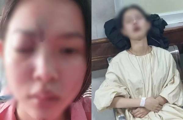Đồng Nai: Công an vào cuộc vụ cô gái trẻ đi tiêm filler bị mù mắt tại Spa