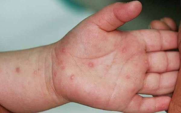 Việt Nam sắp có vắc xin phòng bệnh tay chân miệng