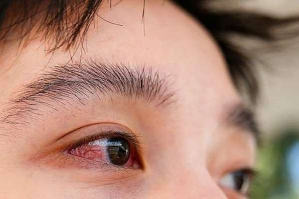 Những lưu ý khi dùng thuốc nhỏ mắt trị bệnh đau mắt đỏ