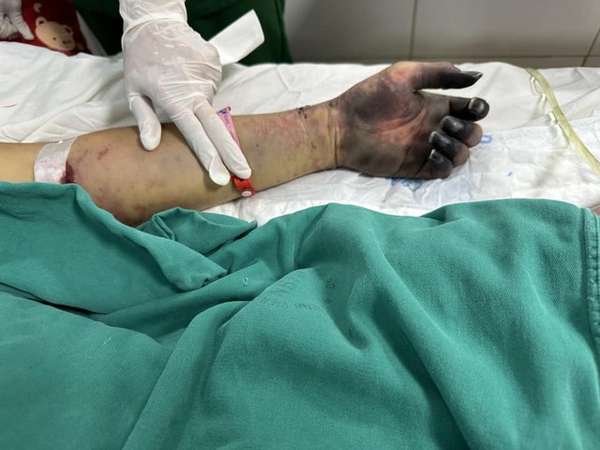 Người đàn ông ở Nghệ An phải cắt bỏ 2 chân, ngón tay do nhiễm liên cầu lợn
